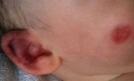 acute hemorrhagic edema of infancy