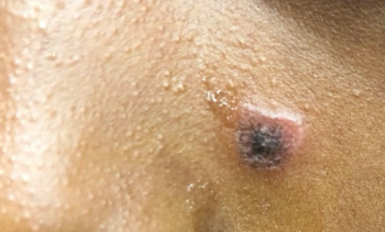 well-circumscribed, annular, erythematous plaques