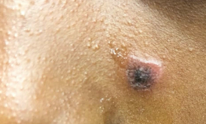 well-circumscribed, annular, erythematous plaques