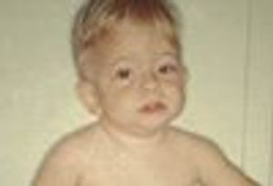 Child With Unusual Appearance, Inguinal Hernia, Accelerated Growth, and Developmental Delay