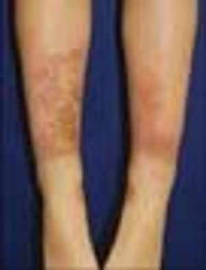 Shin Guard Dermatitis