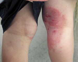 A red itchy rash developed on the patient's right leg