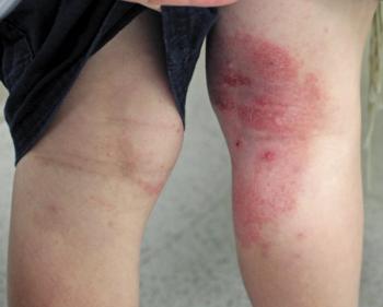 A red itchy rash developed on the patient's right leg