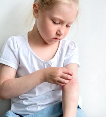 Roflumilast cream 0.05% safe, effective for children aged 2 to 5 years with atopic dermatitis | Image Credit: © Марина Терехова - © Марина Терехова - stock.adobe.com.