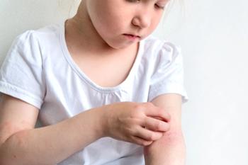 Roflumilast cream 0.05% safe, effective for children aged 2 to 5 years with atopic dermatitis | Image Credit: © Марина Терехова - © Марина Терехова - stock.adobe.com.