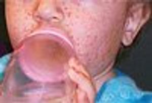 Infant With Persistent Fever and Cough, Worsening Rash
