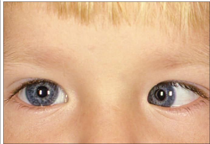 Hirschberg Examples Strabismus: