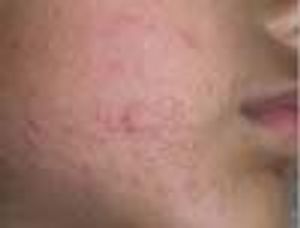 Molluscum Contagiosum on the Face of a 4-Year-Old Boy