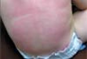 Photoclinic: Immediate Pressure Urticaria