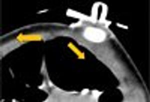 A Toddler Intolerant of Tube Feeding