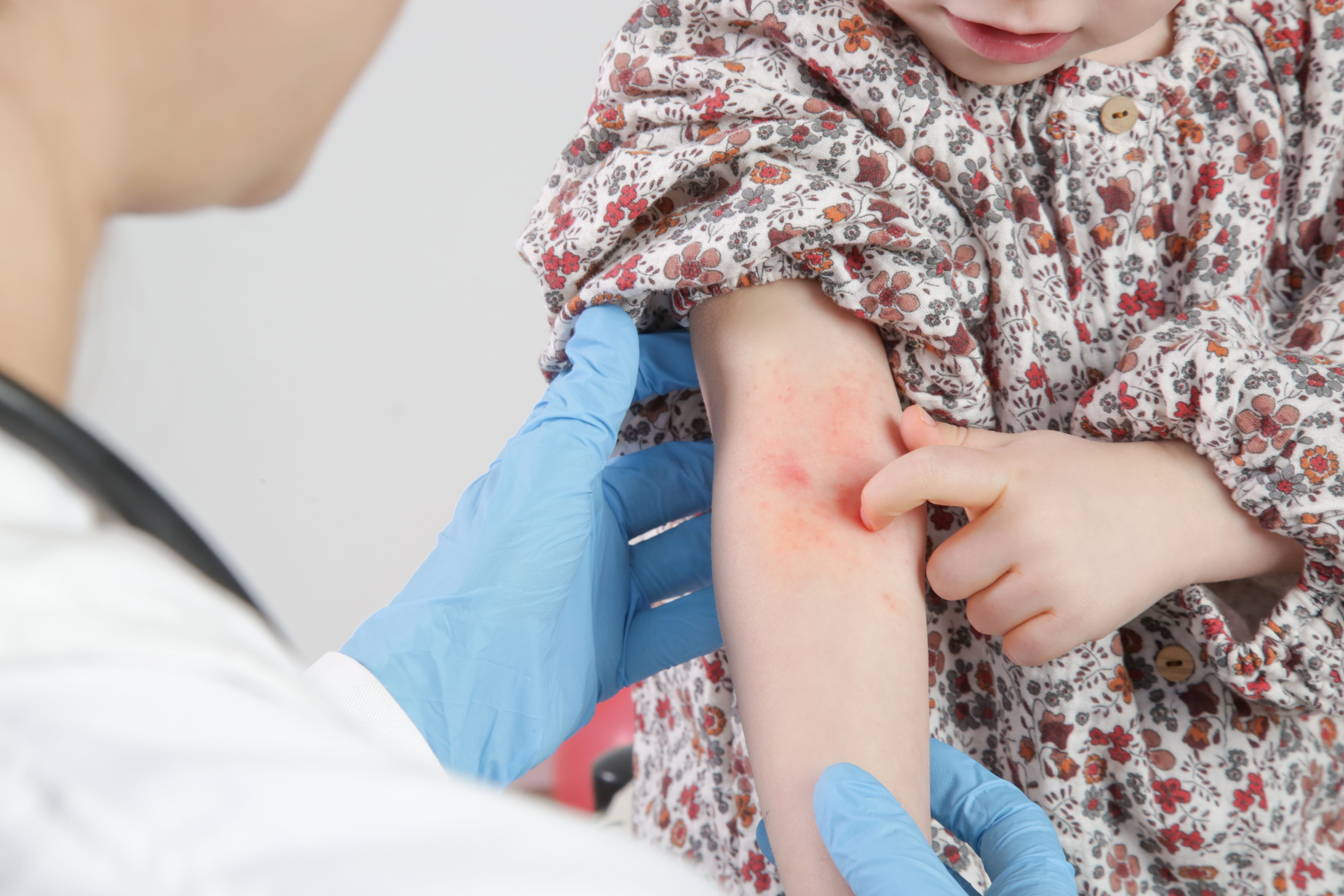 Chronic skin disorders linked to psychological distress and poorer quality of life in children | Image credit: © triocean - stock.adobe.com
