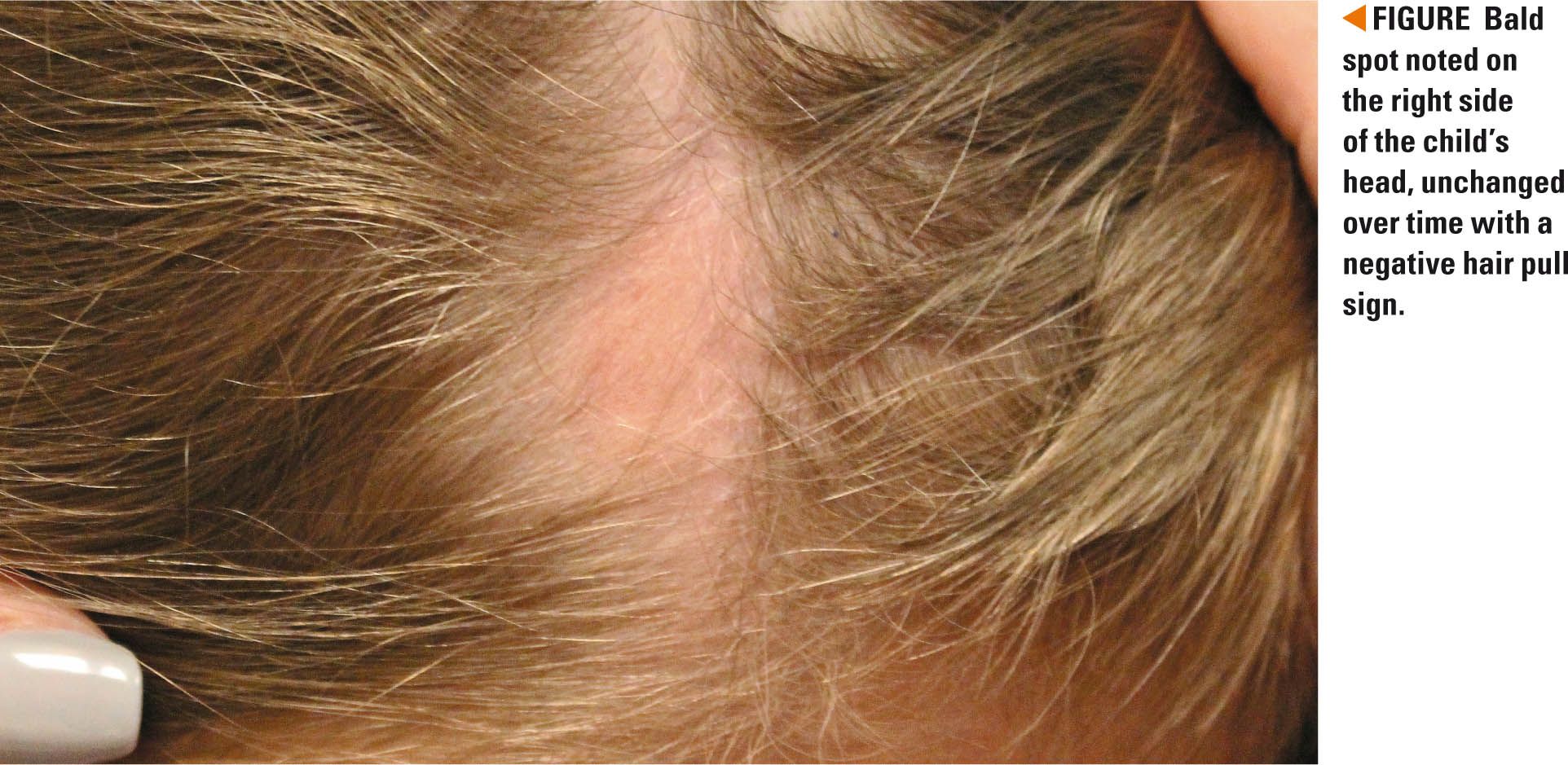 Curious bald spot on a young girl's head
