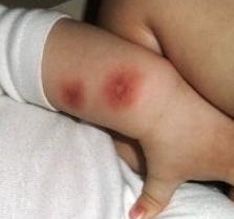 acute hemorrhagic edema of infancy