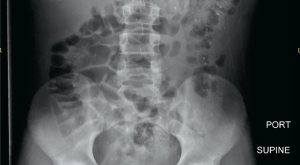 Child with punctate opacities in the colon