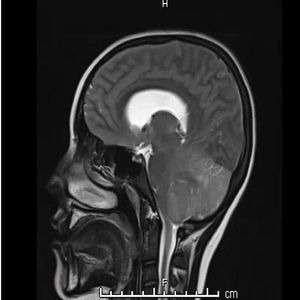 Patient’s Initial Brain MRI | Image credit: Author provided