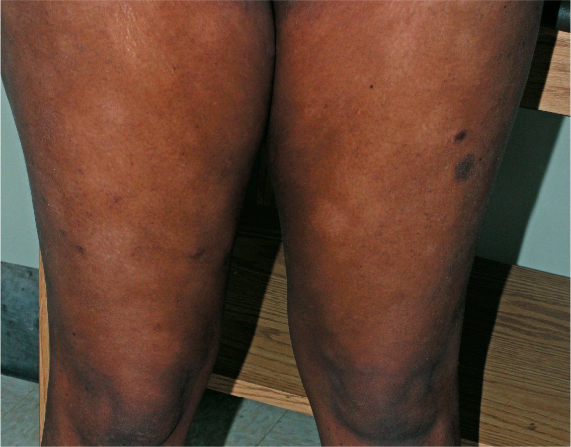 Multiple hypopigmented ovoid macules and patches were noted on the patient's bilateral anterior thighs.