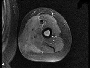 Acute Lymphoblastic Leukemia Presenting as Soft Tissue Mass