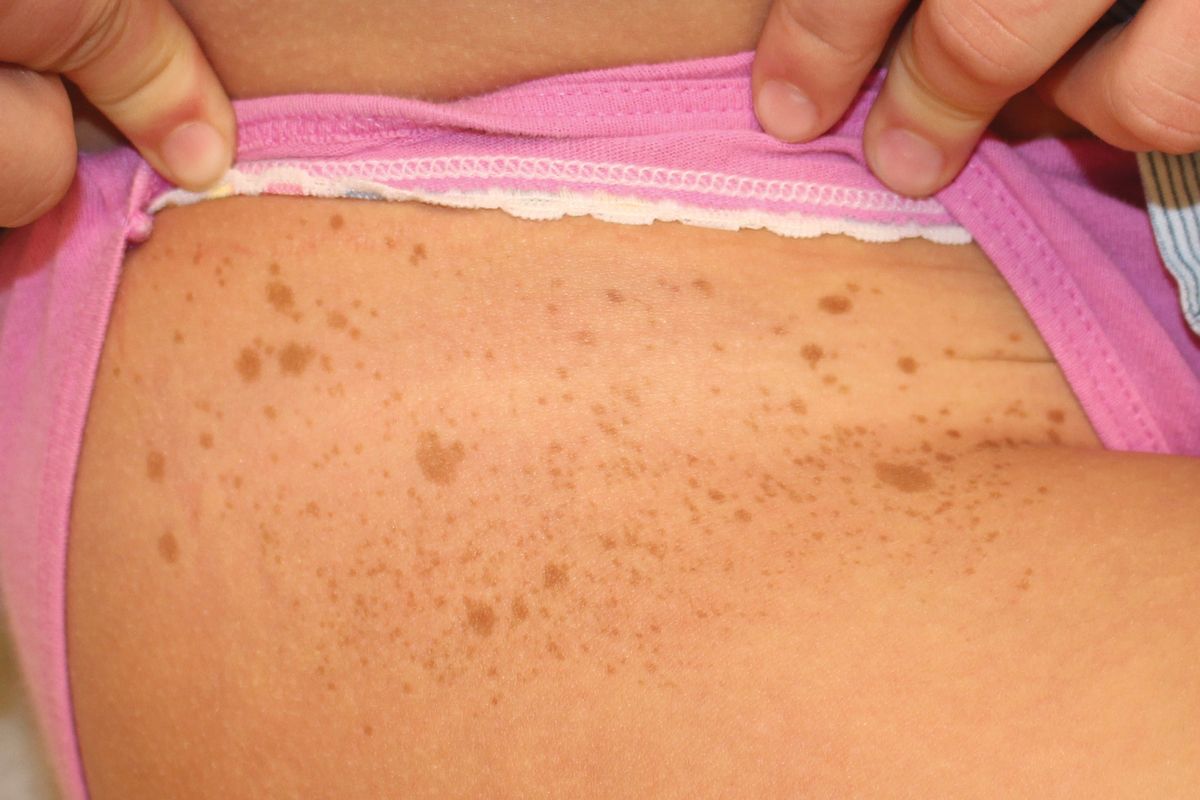 mosaic neurofibromatosis