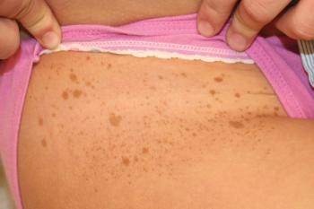 mosaic neurofibromatosis