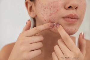 Acne vulgaris in teenagers