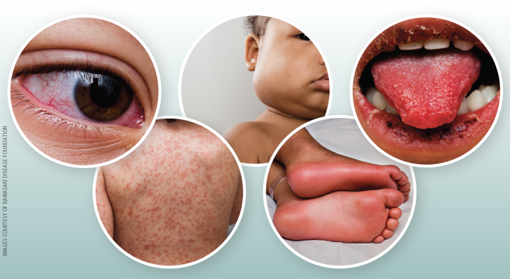 Kawasaki Disease Aha Statement And Recommendations Kawasaki Disease Aha Statement And Recommendations