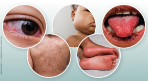 Kawasaki disease: AHA statement and recommendations