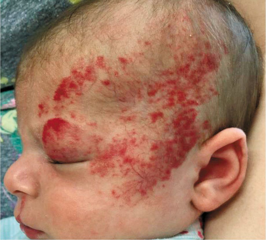 image of child with segmental hemangioma on face
