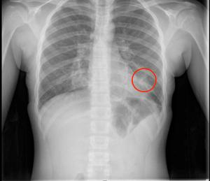 Puzzler: 14-year-old with asthma, vomiting, and vape use presents with chest pain