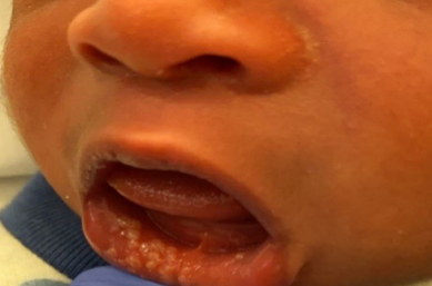 Fordyce spots in neonates are benign, requiring no intervention | Image credit: Author provided