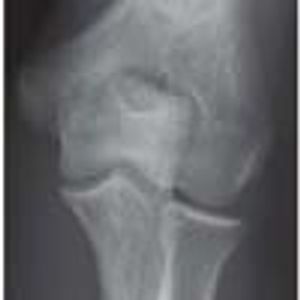 Supracondylar Process