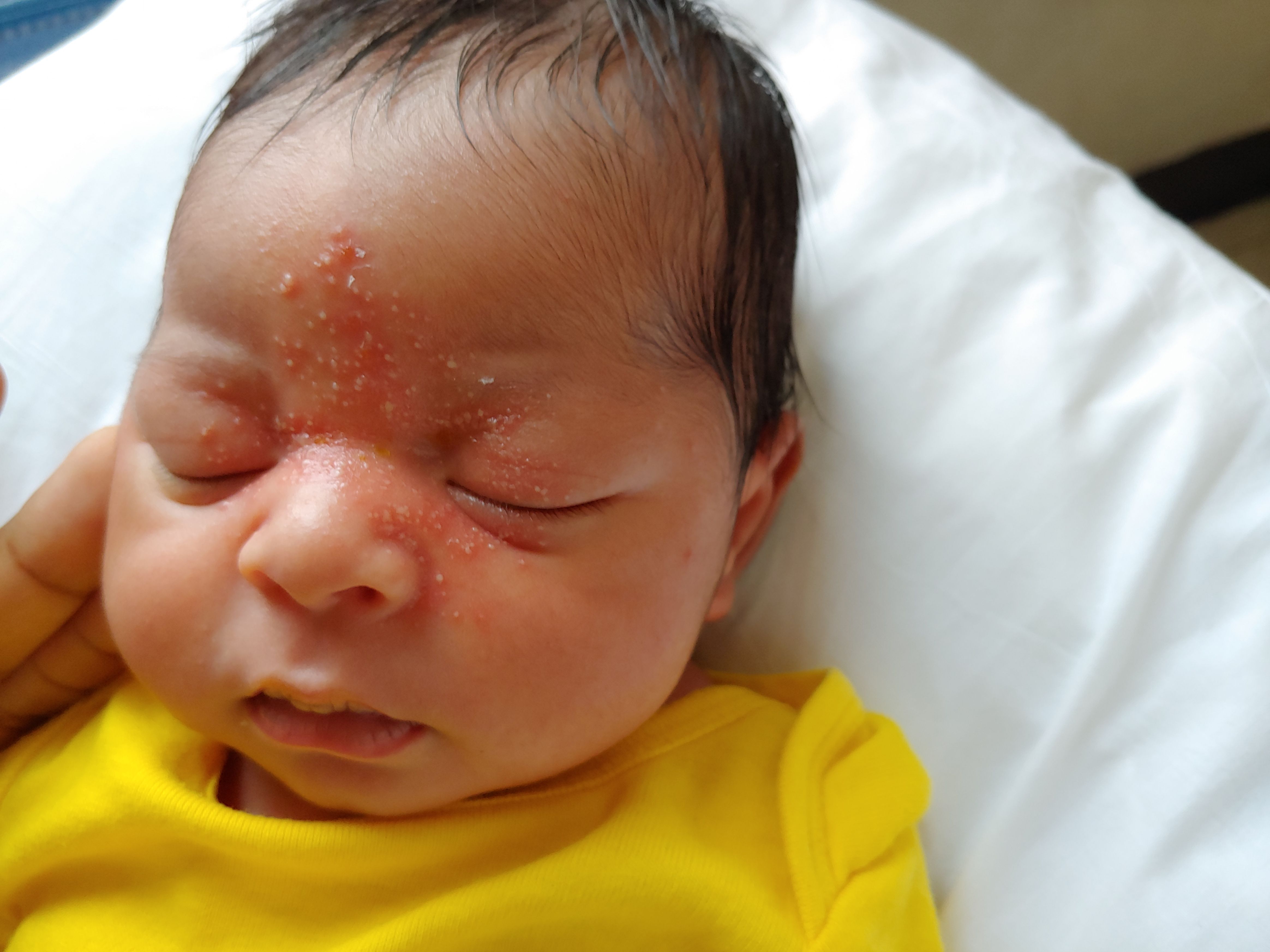 newborn-rashes-and-skin-conditions
