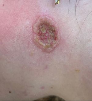 Worsening acne after isotretinoin treatment in an adolescent girl