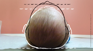A pediatric epidemic: Deformational plagiocephaly/brachycephaly and congenital muscular torticollis
