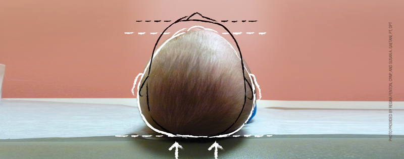 Flat head syndrome
