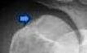 Hill-Sachs Deformity: A Pathognomonic Sign of Anterior Shoulder Dislocation