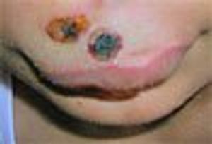 Complicated Cutaneous Anthrax