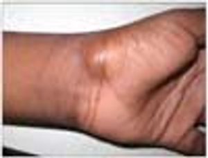 Ganglion cyst