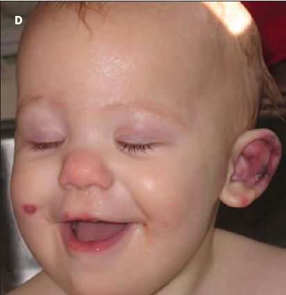 acute hemorrhagic edema of infancy