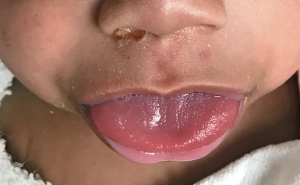 Macroglossia and omphalocele in neonate