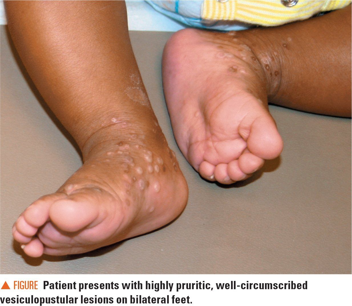 Infant S Pustular Eruption Is Not Scabies