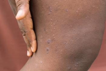 Dupilumab improves atopic dermatitis severity in adolescents, adults with skin of color | Image Credit: © this_baker - © this_baker - stock.adobe.com.
