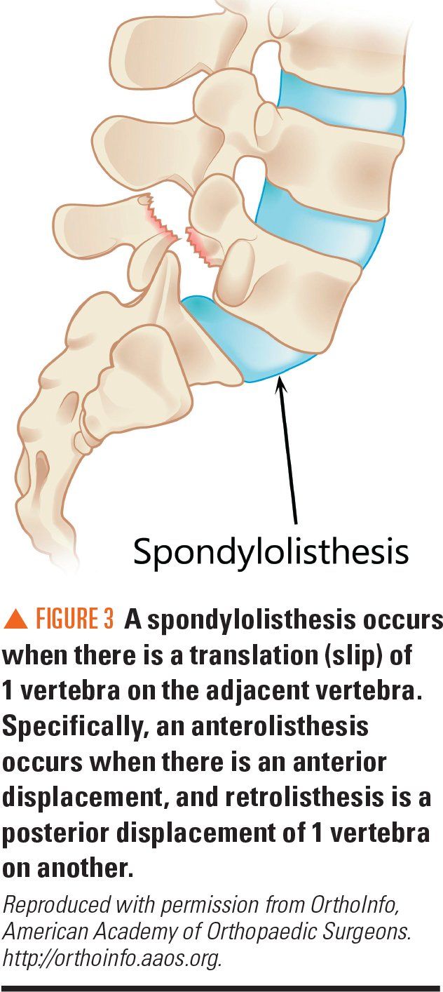 Spondylolysis Underrecognized cause of low back pain