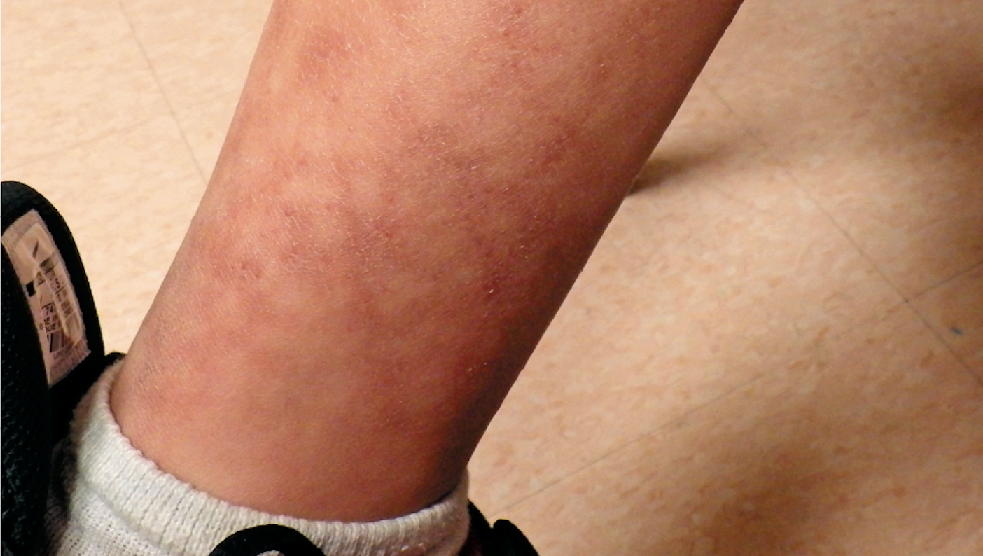 Reticulated Rash On Boy S Lower Extremities Reticulated Rash On Boy S Lower Extremities