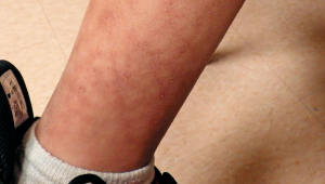 Reticulated rash on boy’s lower extremities