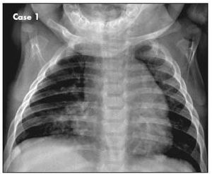 History of Cough in an Infant and a Toddler