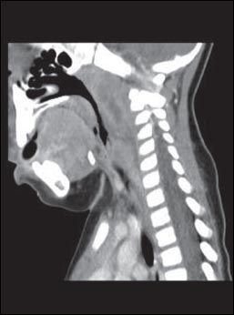 peritonsillar abscess x ray