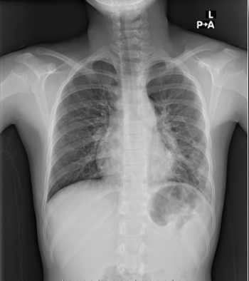 Atypical presentations of Mycoplasma pneumoniae amid a local outbreak | Image credit: Author provided