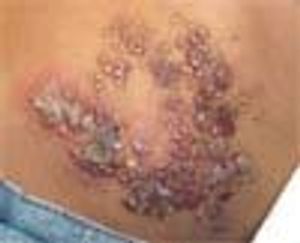 Lymphangioma Circumscriptum With Secondary Cellulitis