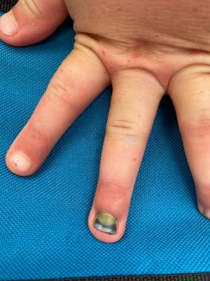 A green nail after trauma in an 8-year-old boy | Image credit: Author provided