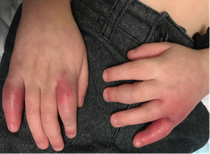 Four-year-old with itchy, red, painful hands following snow exposure